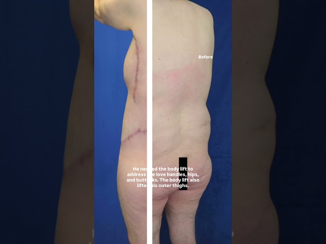 He went to another surgeon for a tummy tuck then came to Dr. K for a body lift. Here are his results