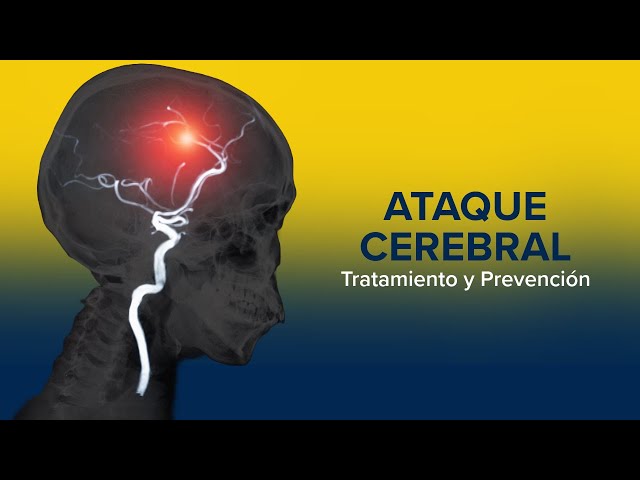 Tratamiento y prevención de un ataque cerebral (ictus) |  UC Davis Health