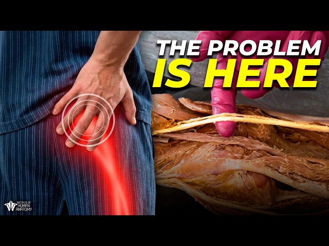 Why Sciatica is So Hard To Fix