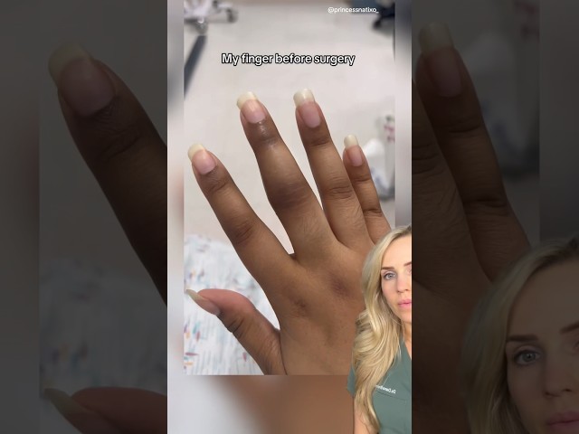 Doctor reacts: finger amputation?!