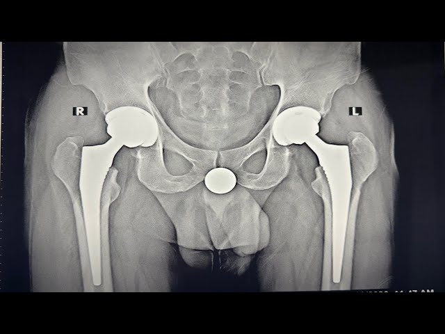 Life After Hip Replacement- Answering Top 5 Most Commonly Asked Questions PART 1 
