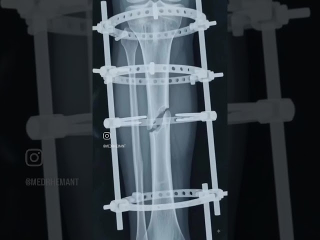 #fracture #cmbbs #cpcexam #anatomy #biology
