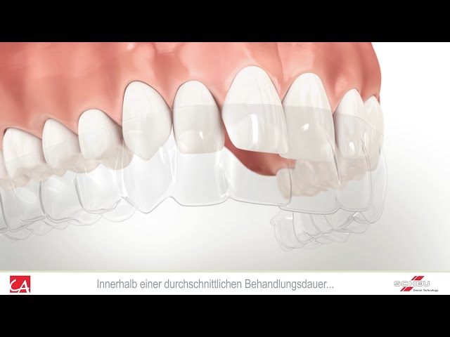 Korrektur von Zahnfehlstellung mit unsichtbarer Schiene
