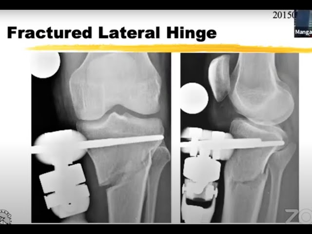 Hinge fracture in opening wedge HTO (fixator)