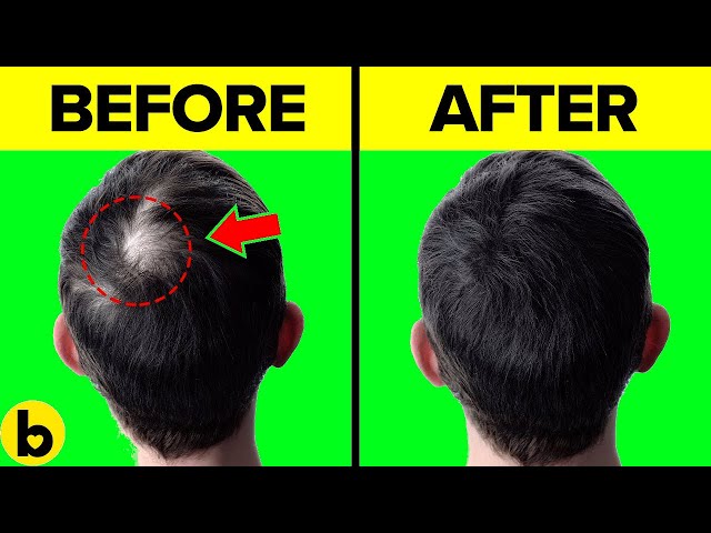 10 PROVEN Tips To RE-GROW Hair FAST - 🚫 WITHOUT Surgery!