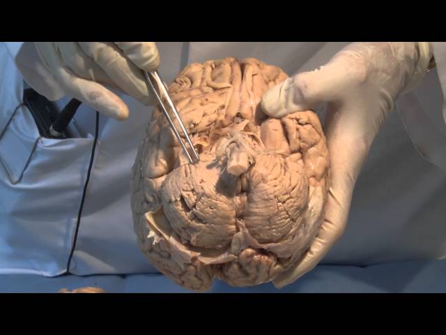 The Meninges: Neuroanatomy Video Lab - Brain Dissections