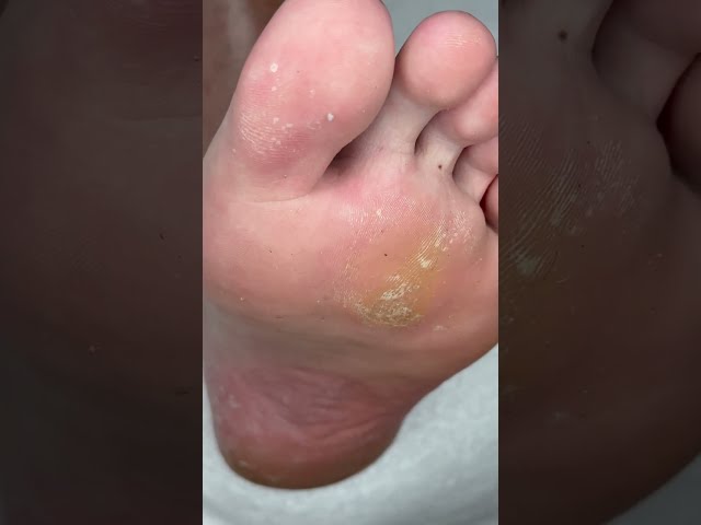 Huge Callus Removal🆘
