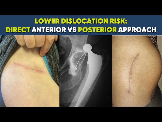 Dislocation Risk in Hip Replacement-Direct Anterior vs Posterior approach 