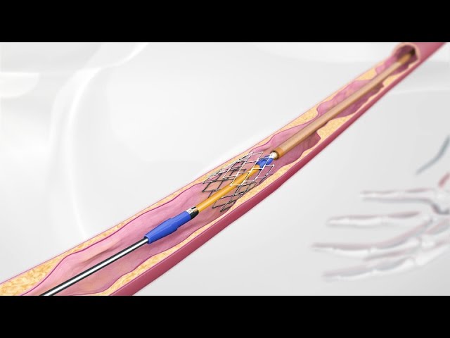 3D Medical Animation: Vascular Stent System for Leg Arteries