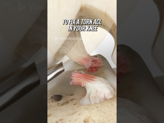 ACL reconstruction using your own tendon (3D Animation)