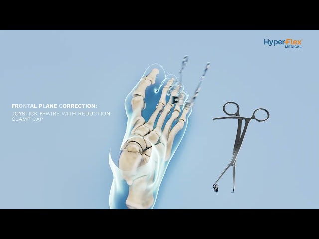 HyperFlex™ Surgical Animation | A Bone-Preserving Approach to Bunion Correction