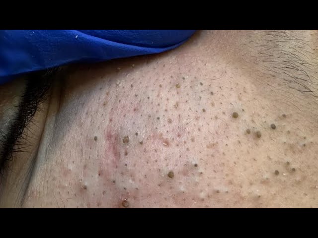 Deep Cleansing Techniques For Oily Skin: Pro Skincare Expert Step by Step Guide!