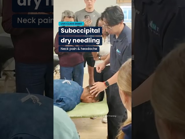 Suboccipital dry needling #manualtherapy #physiotherapist #osteopathy
