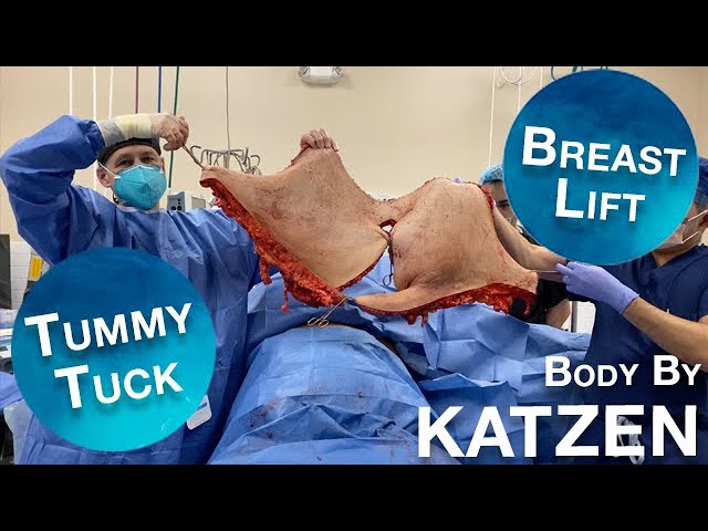 Tummy Tuck with a Breast Lift & Torsoplasty after 120 lb Weight Loss