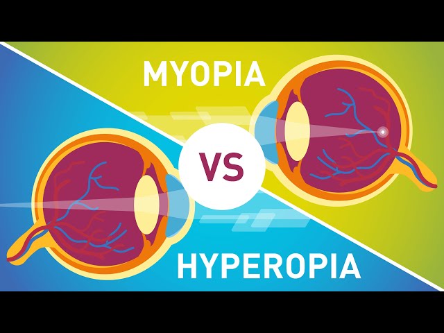 Difference between Myopia (Near Sightedness) & Hyperopia (Far-Sightedness)
