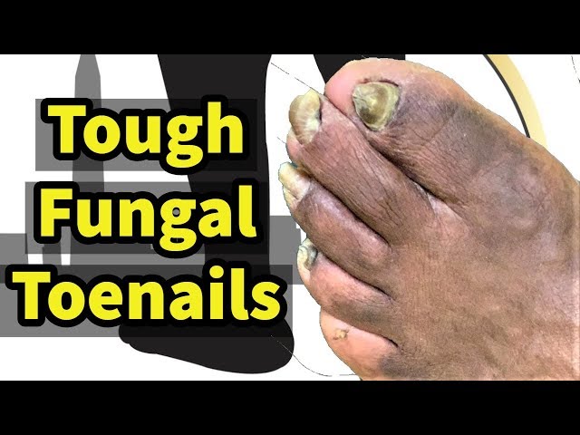 Tough Fungal Toenails:  Treating and trimming thick fungal toenails