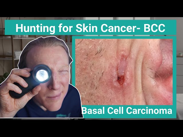 BCC: Basal Cell Carcinoma Skin Cancer: What You NEED to KNOW