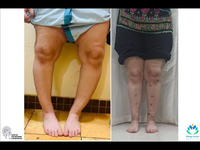Use of Ilizarov for Deformity Correction