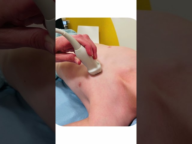 Positioning for Optimal Parasternal Views #Shorts #echocardiography #pediatrics