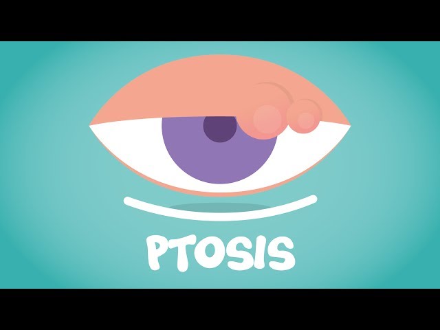 What is Ptosis?