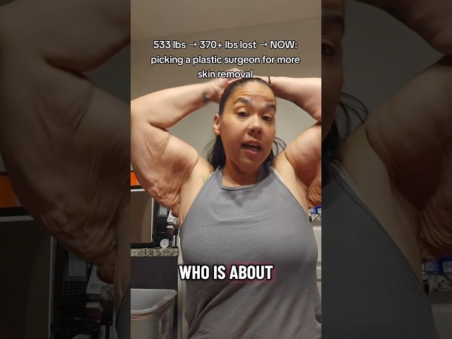She used to weigh 533 lbs and is now ready for skin removal surgery