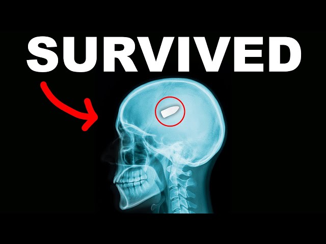 How do People Survive a Headshot?