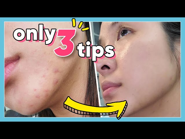 It's Im-PORE-tant: 3 QUICK & SIMPLE ways to get rid of pimples!