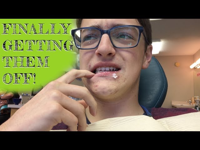 GETTING MY BRACES OFF AFTER 2 YEARS!!