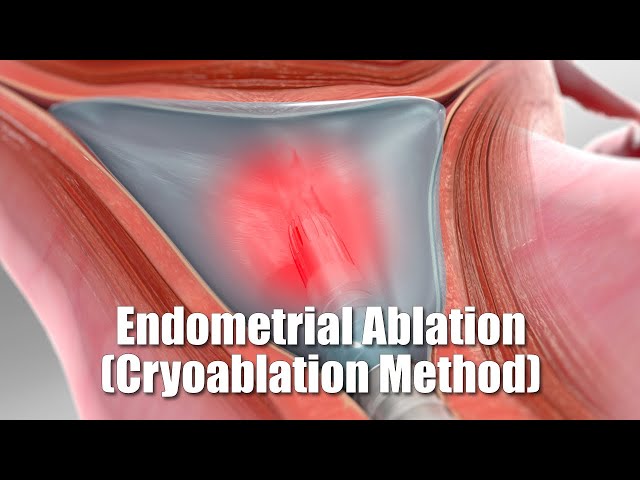 Endometrial Ablation (Cryoablation Method)