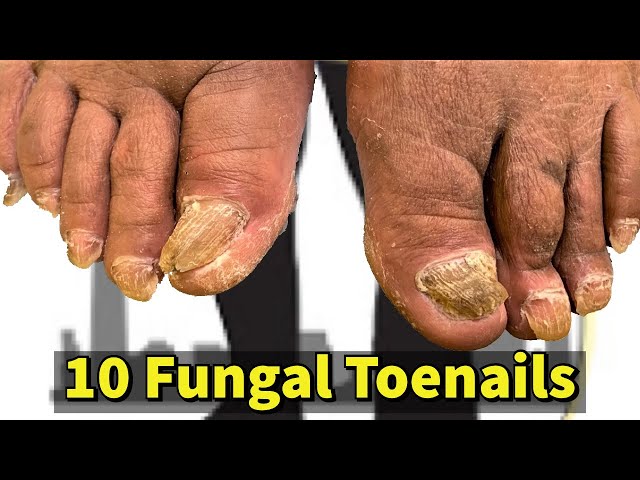 10 Fungal Toenails: Foot Care For A Diabetic (Must See)