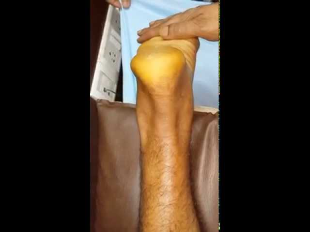 1 week post splintage, 10 days post injury, TA rup