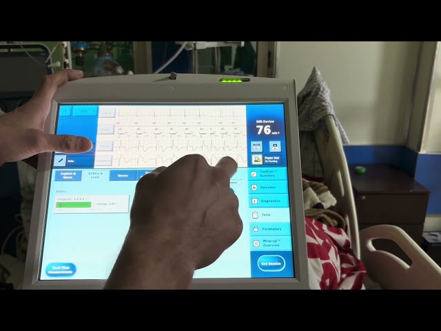 Post Dual Chamber Pacemaker Implant programming of an Abbott/St. Jude Device