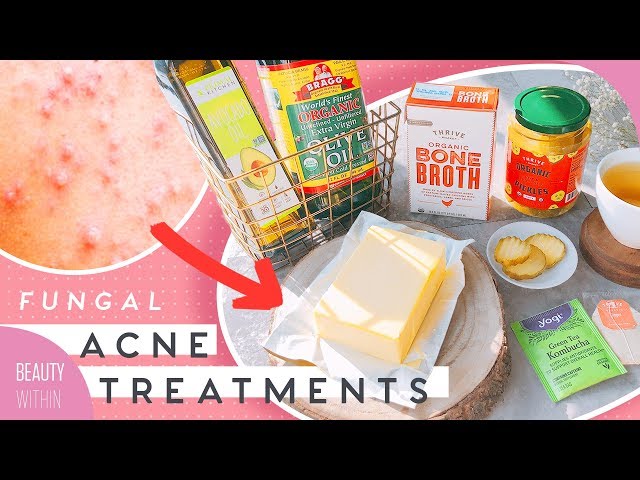 Natural Ways to Clear Skin + Prevent Breakouts, Inflammation & Fungal Acne! 🌿