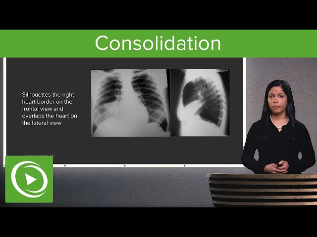 Consolidation – Radiology | Lecturio