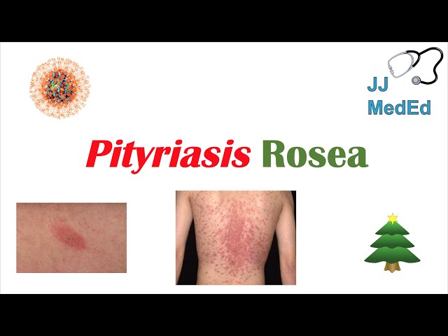 Introduction to Pityriasis Rosea | Possible Causes, Symptoms and Treatment