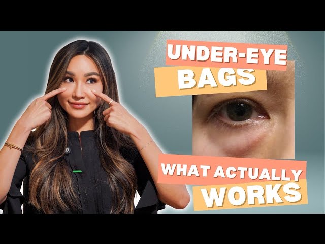 UNDER EYE BAGS: Eye Doctor Explains How To Get Fix
