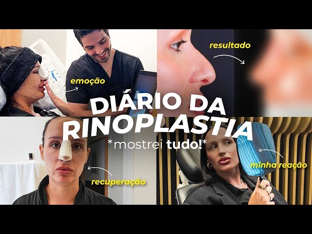 FIZ RINOPLASTIA COM O MELHOR CIRURGIÃO DO BRASIL! O RESULTADO…