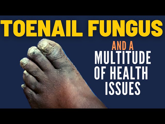 Toenail Fungus and A MULTITUDE of Health Issues (Treatment Plan)