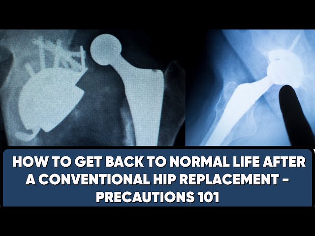 हिप रिप्लेसमेंट -पहले कुछ हफ़्तों किन बातों का खास ध्यान रखें( after conventional Hip Replacement)