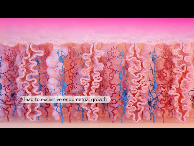Menorrhagia, Heavy Periods | Medical Animation