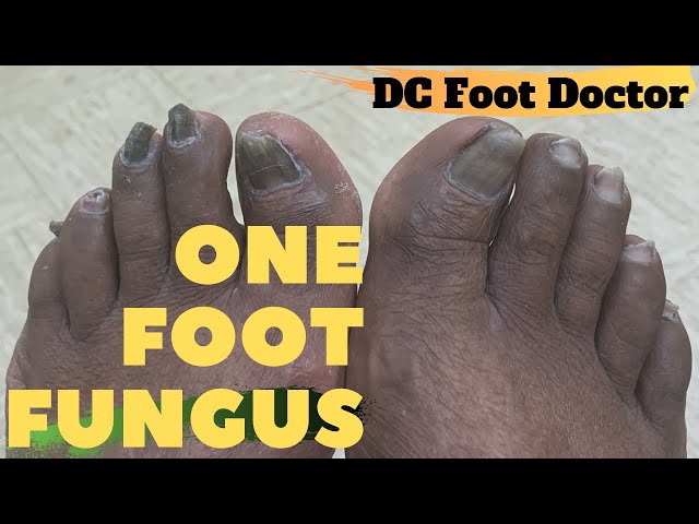 One Foot Fungus: One Sided Toenail Fungal Infection and calluses