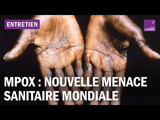 Mpox : sommes-nous prêts pour une nouvelle crise sanitaire mondiale ?