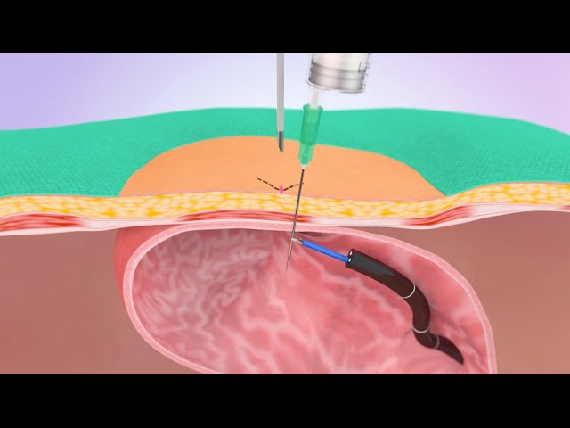 Inserting a PEG gastric tube | Medical animation