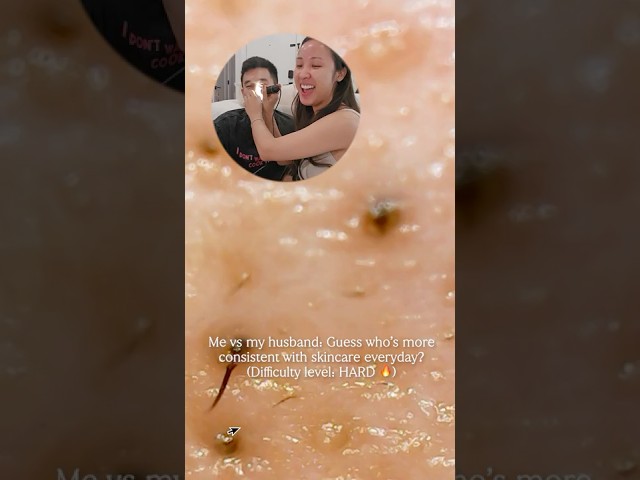 WARNING ⚠️ Exposing our *nasty* pores under a microscope 🔍 😵