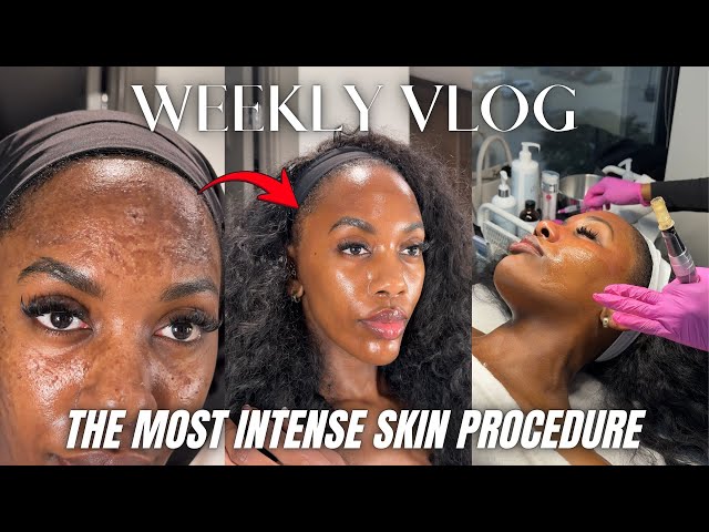 GETTING CHEMICAL PEEL W/ MICRONEEDLING 1ST TIME, INSANE TRANSFORMATION, NEW HOME UPDATES|WEEKLY VLOG