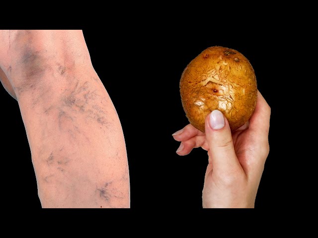 🔥 Impossible ! Say goodbye to varicose veins forever❗ Everyone should know this treasure❗
