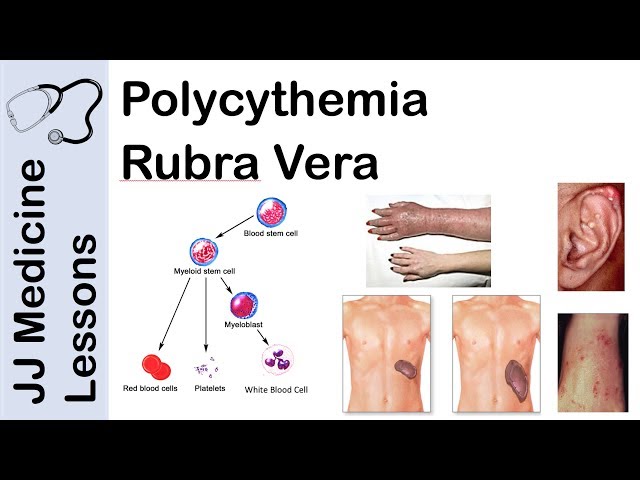 Polycythemia Rubra Vera | Pathophysiology, Symptoms, Diagnosis and Treatment