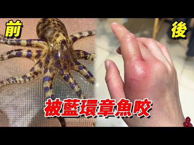 藍環章魚毒性有多猛?光是輕微咬傷就導致手部紅腫,看完再也不敢碰了!【王小怪】