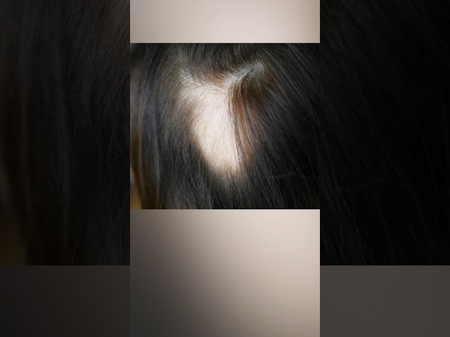 Alopecia Areata, and Scarring Alopecia Explained #hairloss