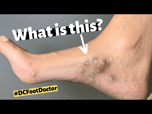 Removal of Unusual Small Calluses: What is This?